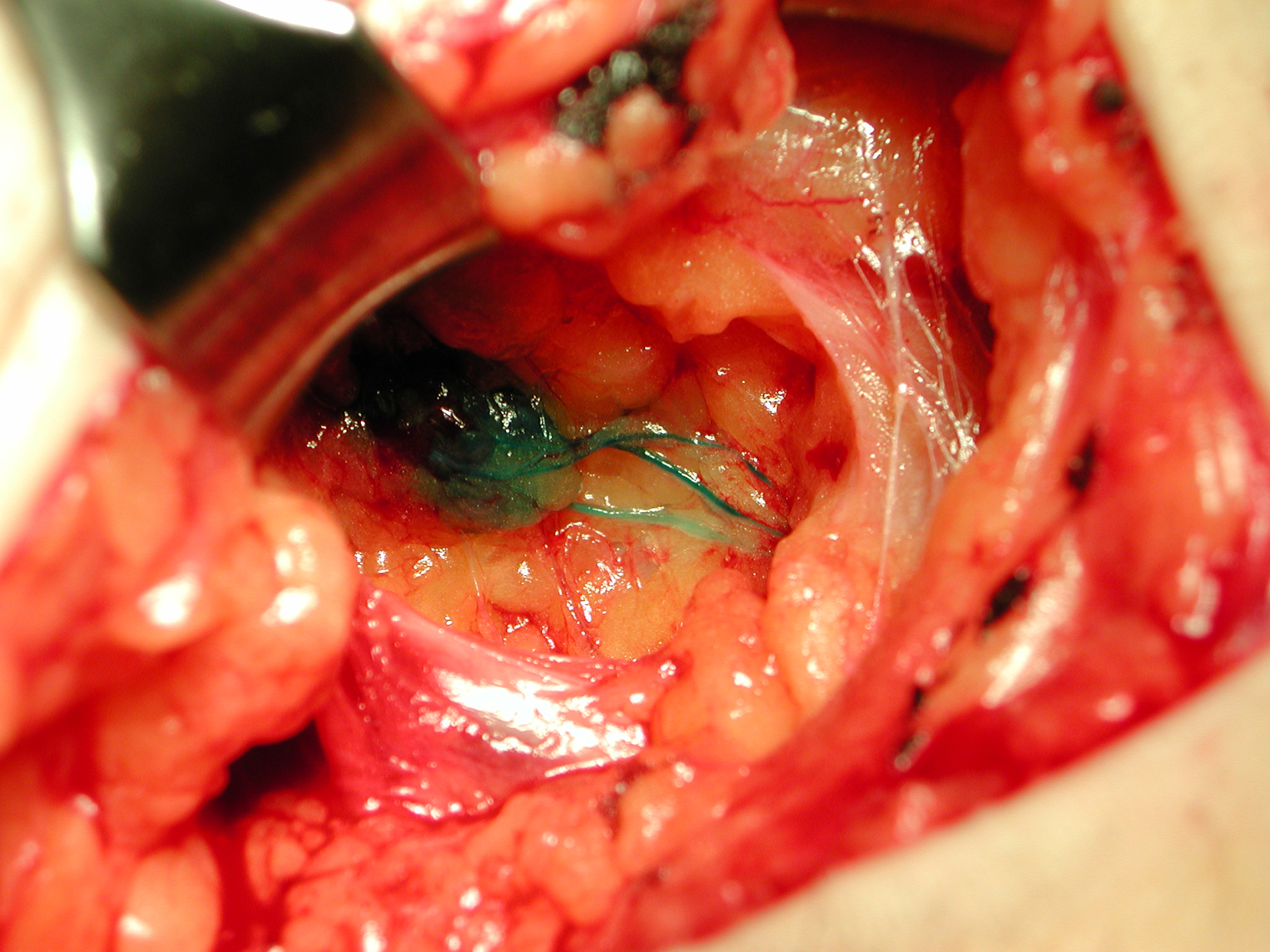 Lymph Node Surgery