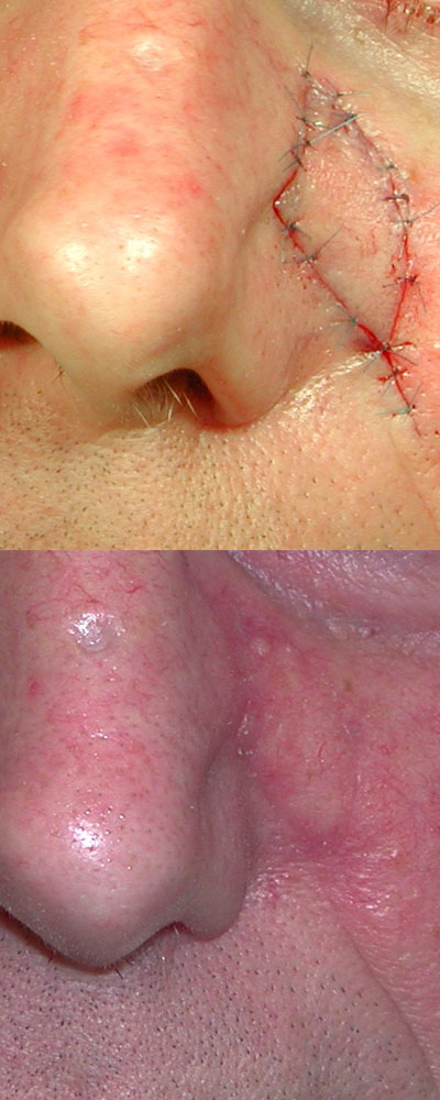 Excision Skin Cancers