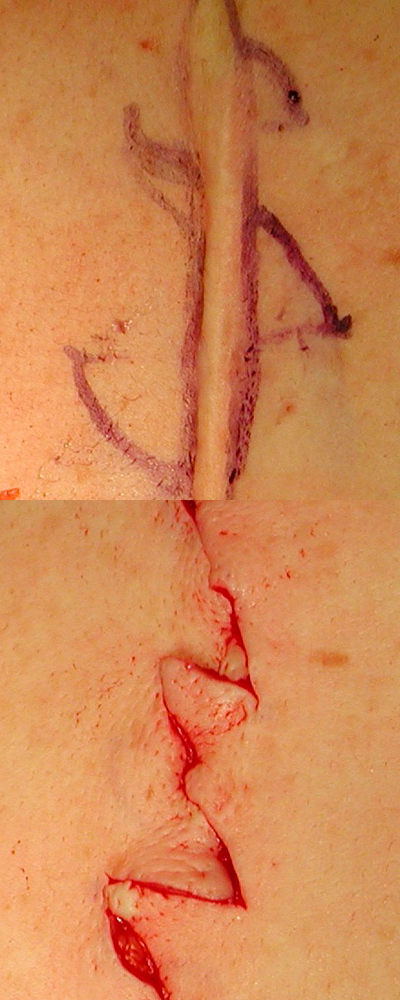 Scar Revision