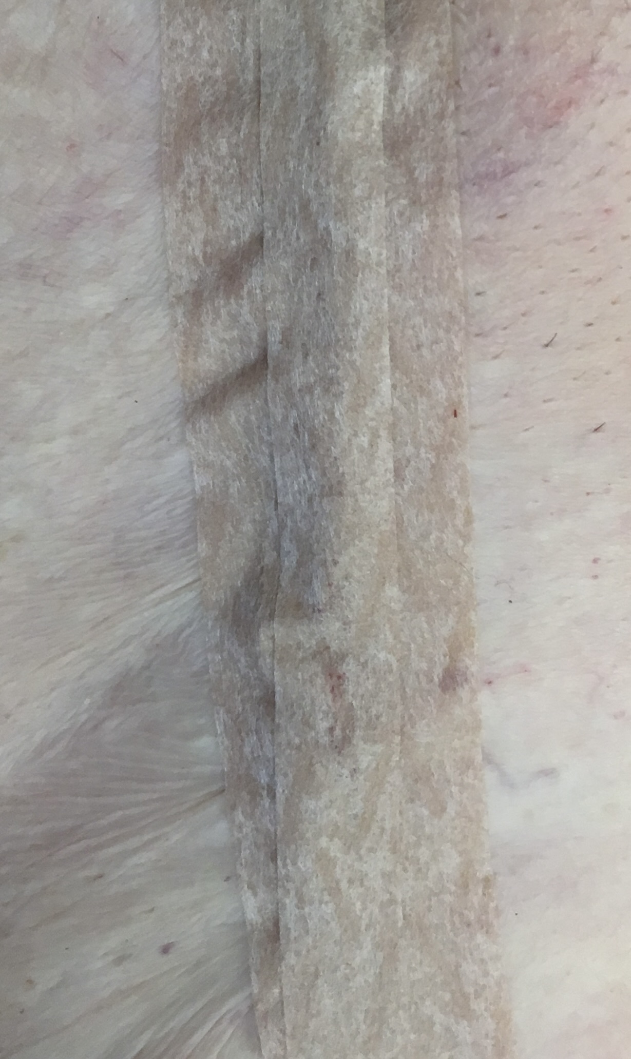 Post-op Wound Care